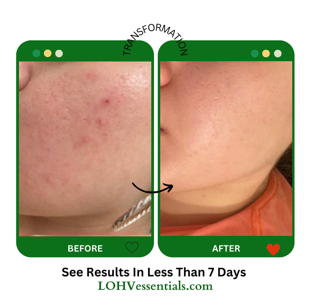 4 STEP PREMIUM 100% VEGAN SKINCARE SOLUTION SYSTEM With Rosemary + Hyaluronic acid + Vitamin C + Retinol + Lactic acid + Glycolic acid + Vitamin E + Niacinamide + Kombucha + Aloe vera